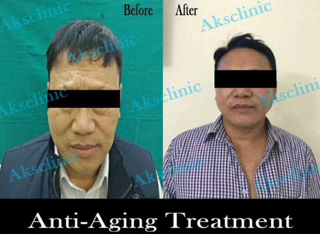 Anti Ageing In gurgaon